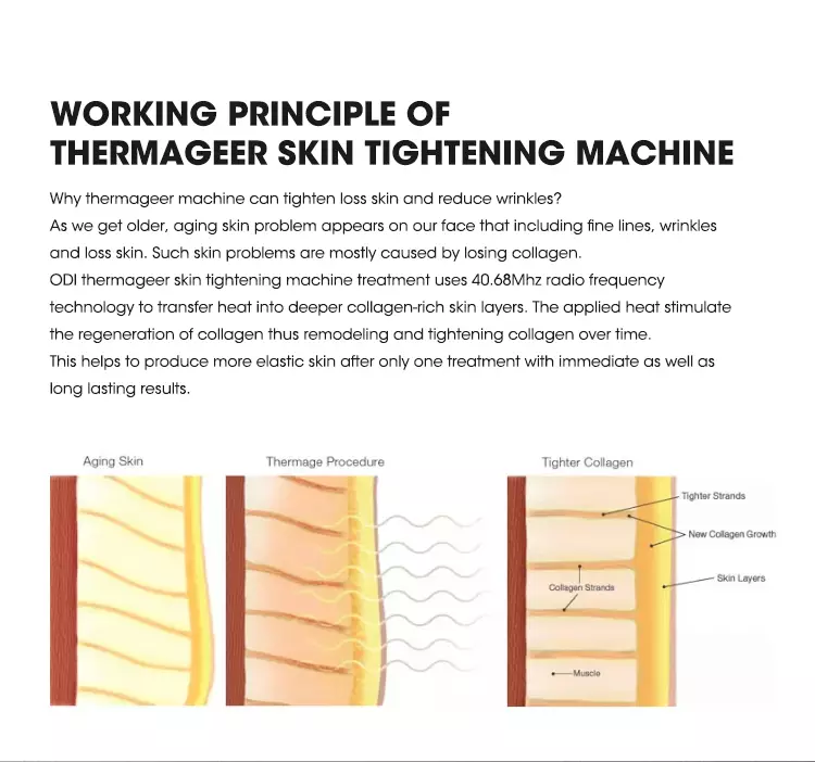 thermage (6)